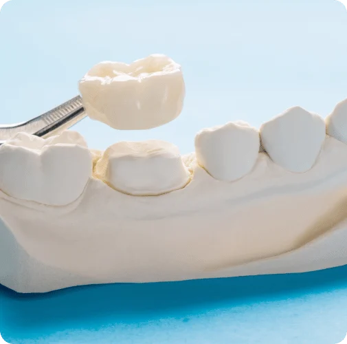 what are veneers | Premier Dental Associates