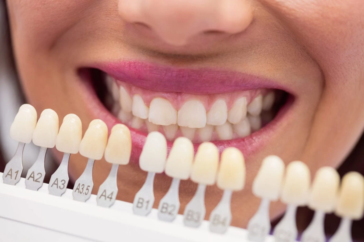 girl-dental-chair-choosing-veneers